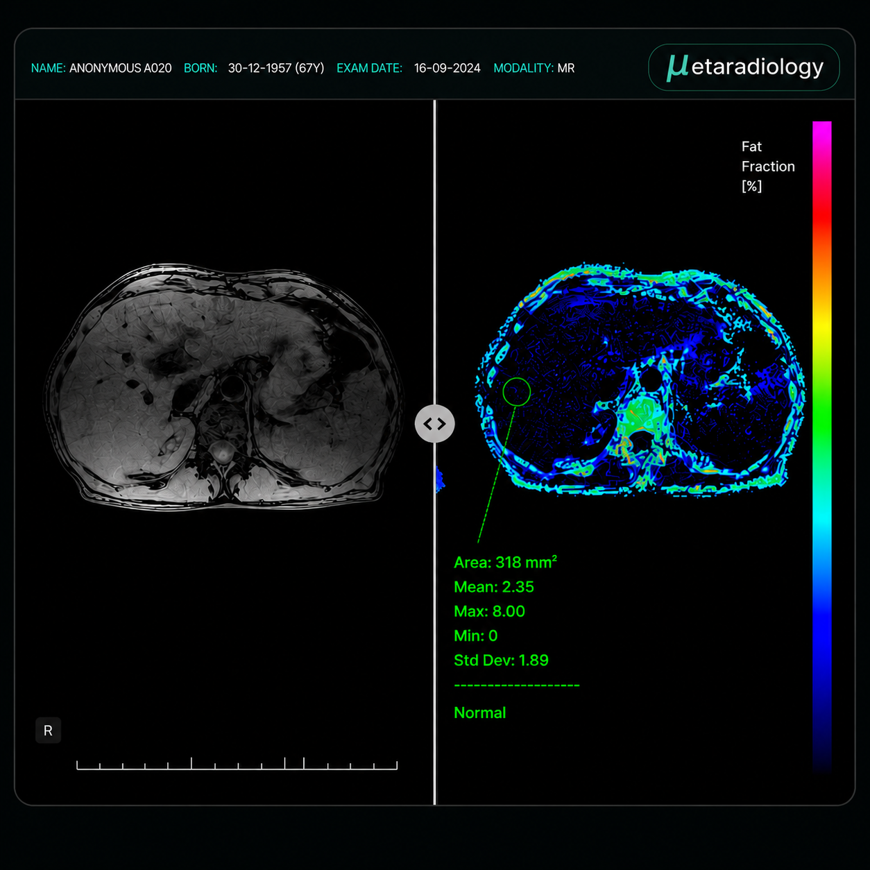 liver steatosis